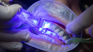 Sbiancamento Dentale con Laser