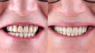 Riabilitazione Dentale Avanzata